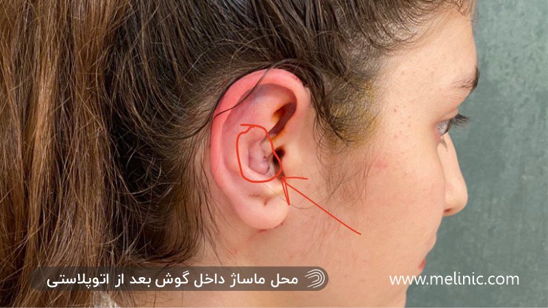 محل دقیق ماساژ داخل گوش بعد از عمل اتوپلاستی