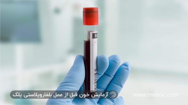 آزمایش خون قبل از عمل بلفاروپلاستی