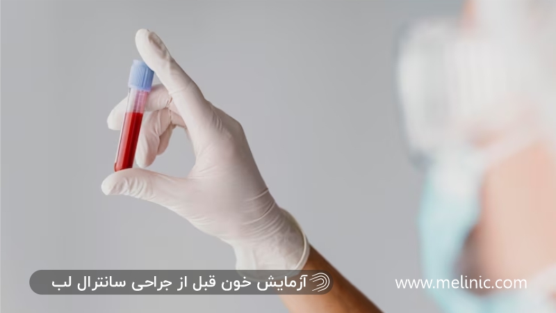 آزمایش خون قبل از سانترال لب