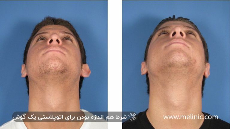 \u0639\u0645\u0644 \u0627\u062a\u0648\u067e\u0644\u0627\u0633\u062a\u06cc \u062a\u06a9 \u06af\u0648\u0634 | \u0645\u0644\u06cc\u0646\u06cc\u06a9