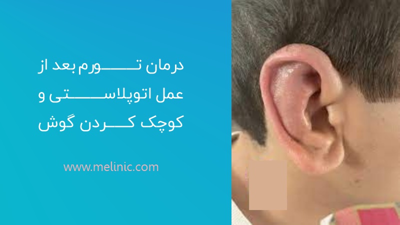 درمان ورم بعد از عمل اتوپلاستی و کوچک کردن گوش