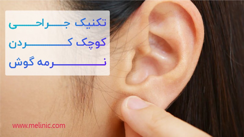 تکنیک جراحی کوچک کردن نرمه گوش