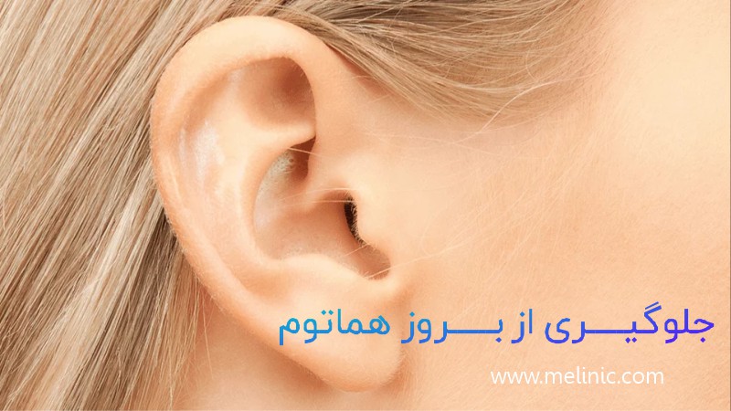 جلوگیری از هماتوم بعد از عمل اتوپلاستی و کوچک کردن گوش