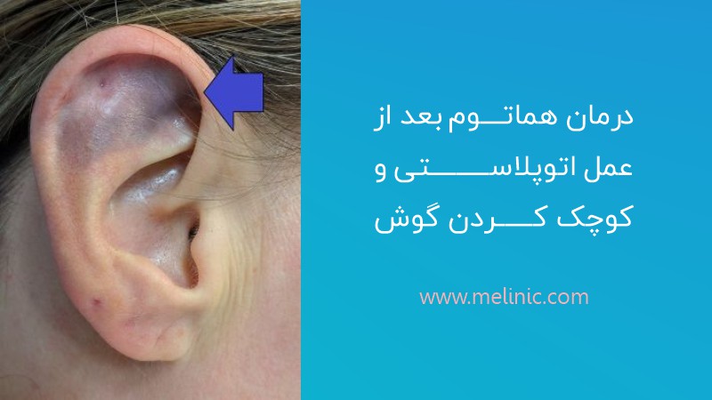 درمان هماتوم بعد از عمل اتوپلاستی و کوچک کردن گوش