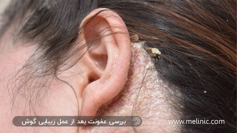 عفونت بعد از عمل اتوپلاستی و کوچک کردن گوش