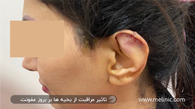 تاثیر مراقبت از بخیه ها بر بروز عفونت بعد از عمل گوش