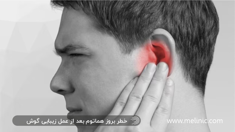 خطر هماتوم بعد از اتوپلاستی و کوچک کردن گوش