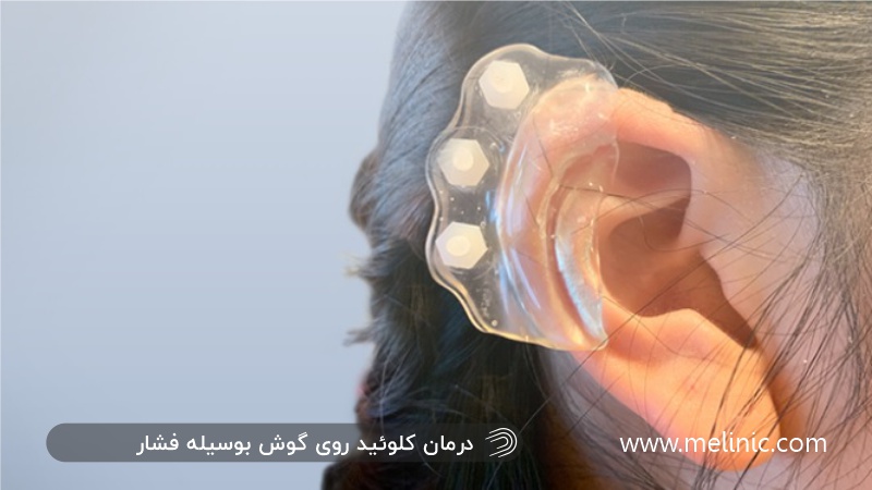 درمان کلوئید روی گوش با فشار