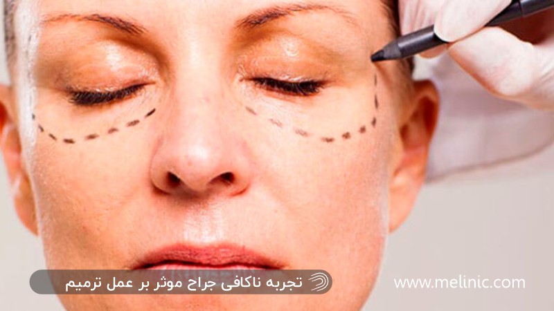 تجربه کم جراح برای عمل بلفاروپلاستی