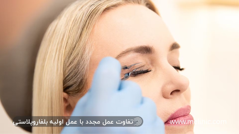 تفاوت عمل بلفاروپلاستی و عمل پلک ترمیمی
