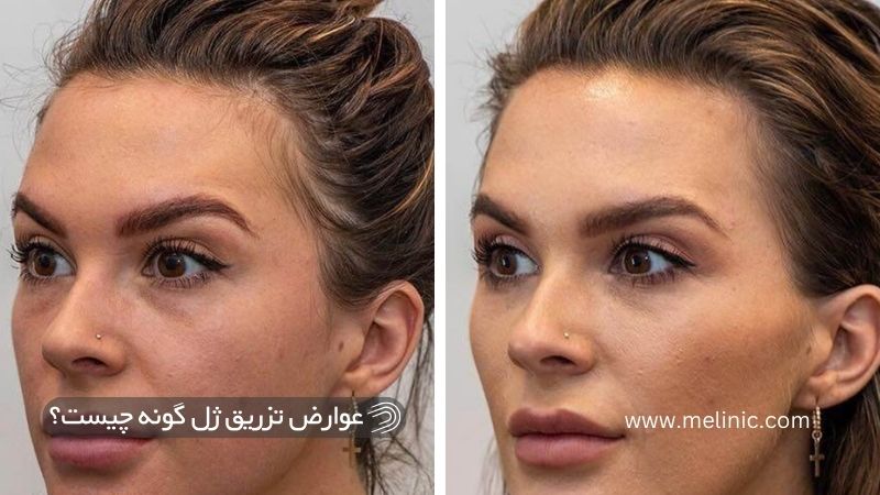 عوارض بعد از تزریق ژل گونه چیست؟