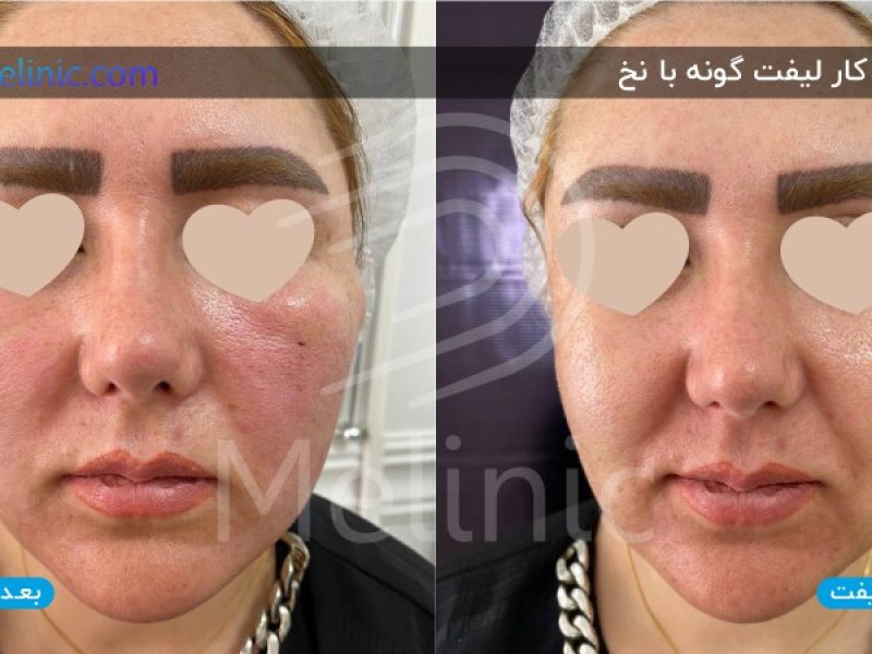 نمونه کار لیفت گونه با نخ