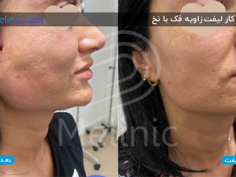 نمونه کار لیفت زاویه فک با نخ