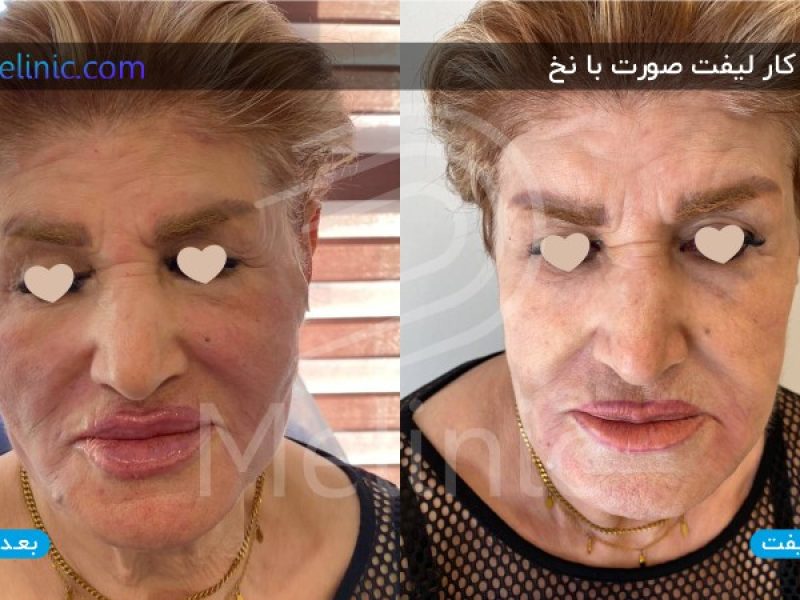 نمونه کار لیفت صورت با نخ